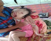 liveleak dot com 32d 1492690789 thai child suffers monstrous facial defo 1492692155.jpg from えろ小学生 アウロリ
