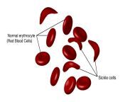 sickle cell disease.jpg from xxx sickle cell anemia diagnosis and treatment screening test for scd bone marrow transplantation sex porn videos download