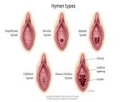 imperforate hymen type.jpg from show hymen