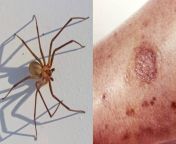 how to treat a spider bite and when to seek medical attention jpgimgsize118313 from spiderbittes