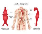 echelon health aortic aneurysm.jpg from wwwaorata