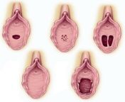 hymen1.jpg from vagina seal open