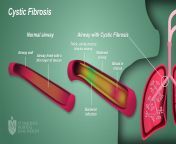 3 svh lung health cystic fibrosis final.jpg from cf