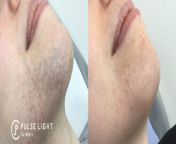blog chin 768x290.jpg from face shaving before laser hair removal less growth am rafia