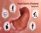 medical animation showing symptoms of rapid gastric emptying.jpg from emptying