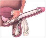 types of penile prostheses 1.jpg from www panis