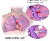 chronic.pulmonary.embolism.in.left.pulmonary.artery.jpgitokttyntnw. from 19 oxxx pht