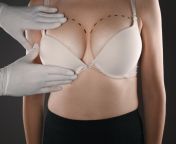 vcc breast augmentation blog.jpg from breast surgery