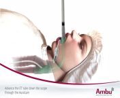 intubation with ambu ascope through 5 thumbnail.jpg from intubated jpg