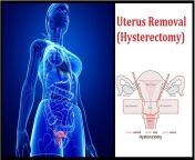 6a4d0c56493a6c3bac6faab5d7c37aa1.jpg from indian aunty uterus operation