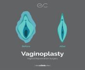 b99d20fa957063eac804582095d0adcc.jpg from female to male vulva plastic surgery