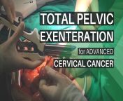 maxresdefault.jpg from total pelvic exenteration for locally advanced