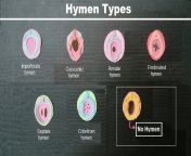 hymen types and shapes pngresize800445ssl1 from blood virgin hymen defloration