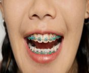 teeth braces 1296x728 header jpgw1155h1528 from braces sex