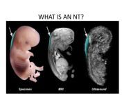 nuchal translucency sequential screening 24 1024 jpgcb1422634129 from period nt photo