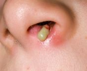 pus from nasal abscess dr p marazziscience photo library.jpg from puzsx