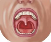 looking into open mouth showing uvula elise walmsley mac wha.jpg from uvula teeth
