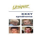 xxxy syndrome ftnwpub unique the rare chromosome.jpg from xxxy
