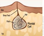 pilonidalcyst a enil.jpg from tight pus