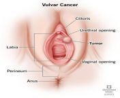 6220 vulvar cancer from laxbia