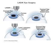 21805 lasik eye surgery from ljsij erfye