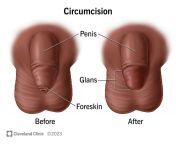 circumcision from penis foreskin