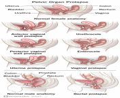 24046 pelvic organ prolapse from prolapsed uterus