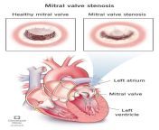 21903 mitral valve stenosis from gujrati open sexi video hd desi sex xxx widowed