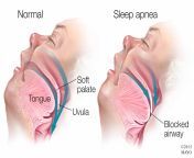 medical illustration of sleep apnea.jpg from sleep redwap