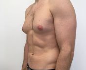 male breast reduction male breast reduction 25.png from gyno