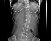 amanda scoliosis slide.jpg from scoliosis scan