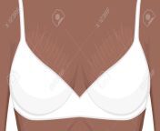 92400795 vector illustration human body problem stretch marks on african american indian woman female for.jpg from indian white boobs