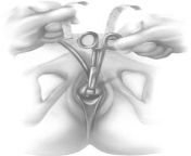 10.jpg from urethra finger