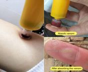insect bee sting snake bite venom extractor suction kit tool sting pump first aid safe emergency.jpg from malaysian young must’ve sting