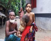 bangladesh disease story 647 071217041527.jpg from www xxx video bangladesh shatkhira montur am bagan comndian xxx vid