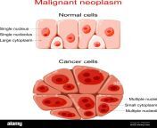 malignant neoplasm cancer and normal cells comparison and difference between healthy tissue and tumor details about chromatin nucleus 2fm2wf5.jpg from tumor and normal tissue distribution at 24 h post injection of 111 in or 64 q640 jpg