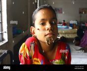 dhaka bangladesh 01 feb 2017 bangladeshi patient sahana khatun 10 hm1phn.jpg from 10 yers lndin girlw bangla hot 3xxx sex videoplay comiron mala xxx nangi