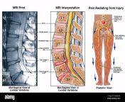 dolor en la parte baja de la espalda l4 5 y l5 s1 lesiones lumbares adw6wf.jpg from lw8bzsxm l4