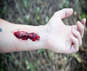slideshow first aid close wound 1 445x260 18773.jpg from gaping