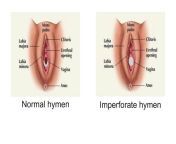 hymen1.jpg from www first time vagina
