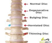 difference between bulged herniated disc jpgv1526327184 from bulge dish