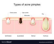 types of acne pimples cross section of human skin vector 40743272.jpg from puzsx