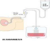 bladder washing1 compression.jpg from 炮机 尿道棒 膀胱注入