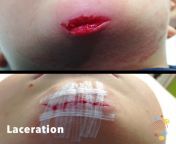 o37 1024x1024.jpg from laceration